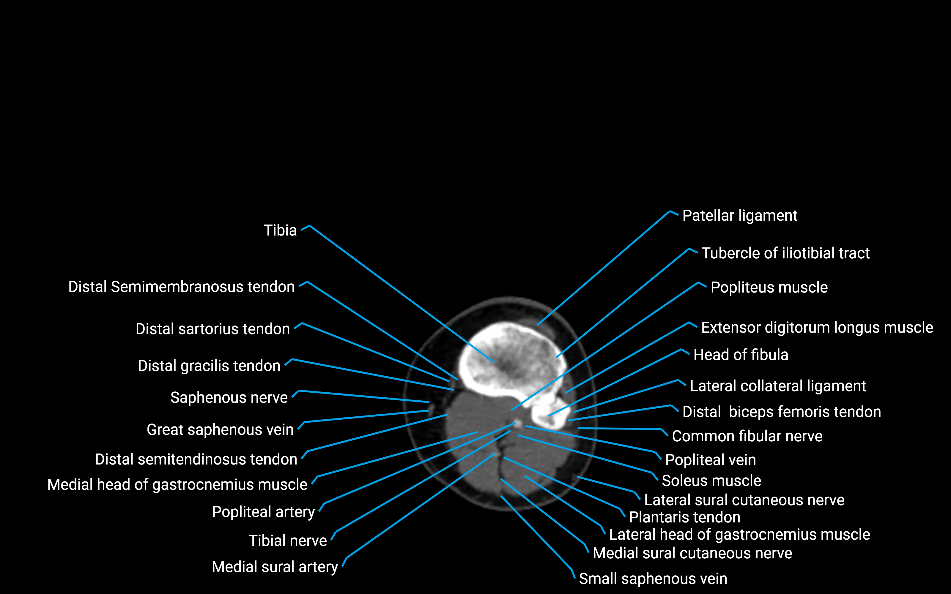 CT Lower leg axial cross sectional anatomy labelled image 95 (2).png